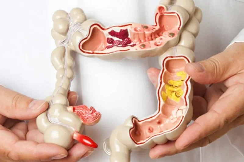 medicamento para hemorroida em Goiás